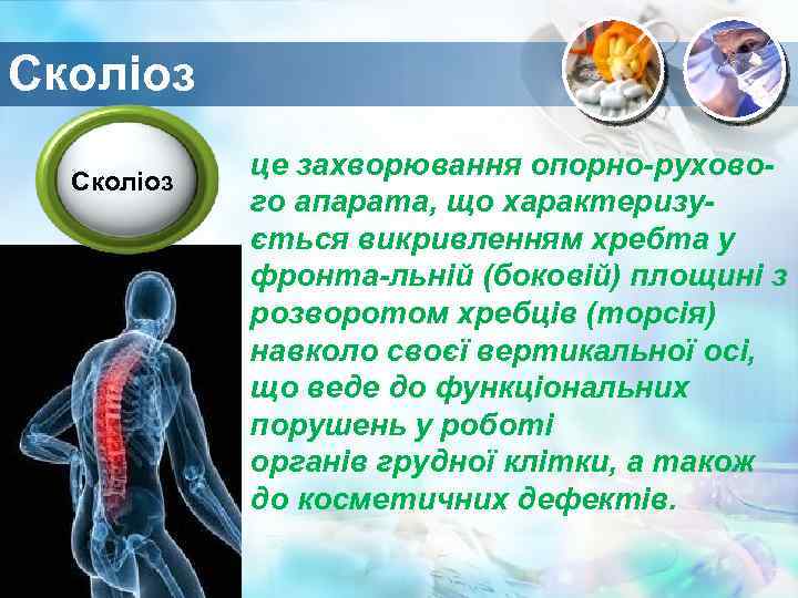 Сколіоз це захворювання опорно-рухового апарата, що характеризується викривленням хребта у фронта-льній (боковій) площині з