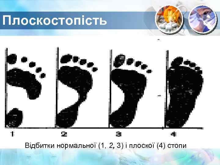 Плоскостопість Text in here Відбитки нормальної (1, 2, 3) і плоскої (4) стопи 