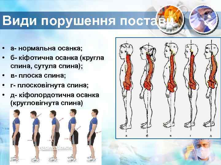 Види порушення постави • а- нормальна осанка; • б- кіфотична осанка (кругла спина, сутула