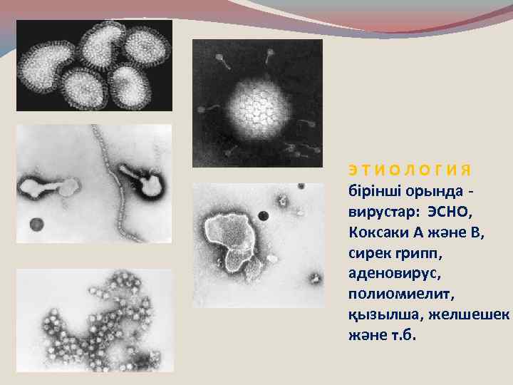 ЭТИОЛОГИЯ бірінші орында вирустар: ЭСНО, Коксаки А және В, сирек грипп, аденовирус, полиомиелит, қызылша,