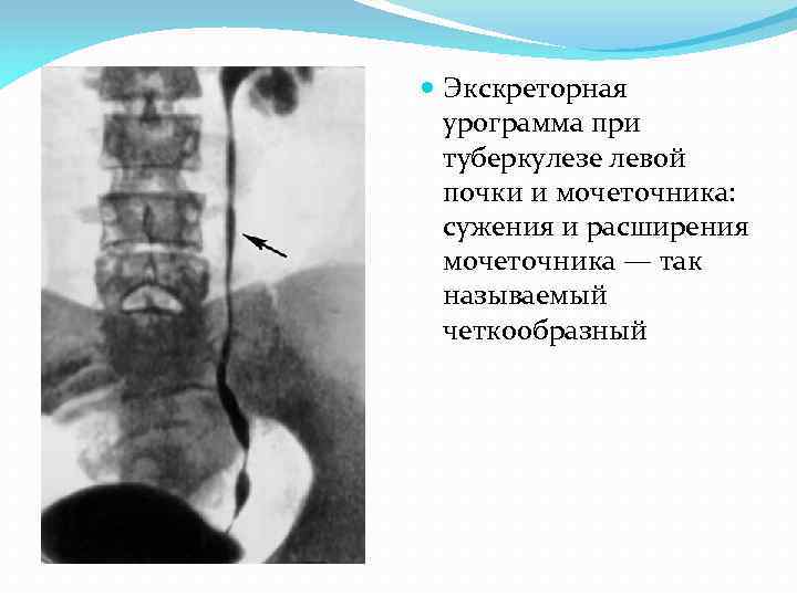  Экскреторная урограмма при туберкулезе левой почки и мочеточника: сужения и расширения мочеточника —