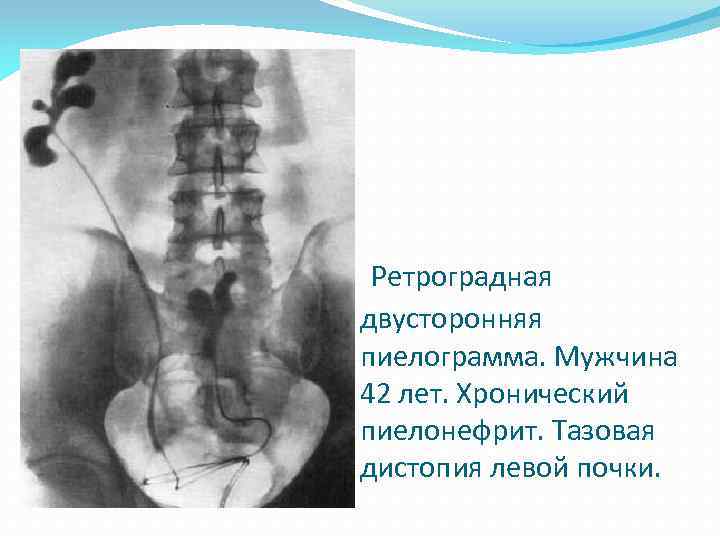 Ретроградная двусторонняя пиелограмма. Мужчина 42 лет. Хронический пиелонефрит. Тазовая дистопия левой почки. 