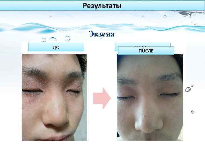 사용 후 ДО Экзема 사용 전 사용 후 ПОСЛЕ 