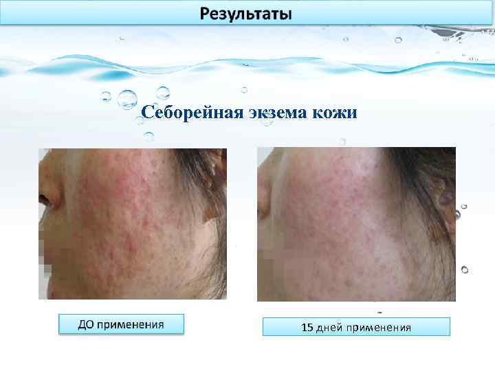 Себорейная экзема кожи 15 дней применения 