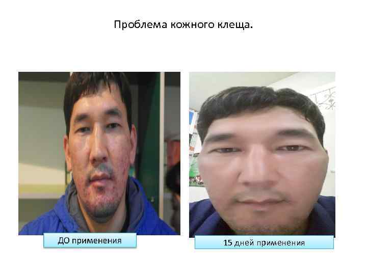 Проблема кожного клеща. 15 дней применения 