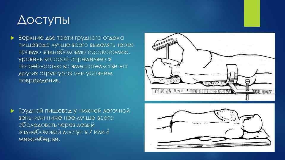 Доступы Верхние две трети грудного отдела пищевода лучше всего выделять через правую заднебоковую торакотомию,