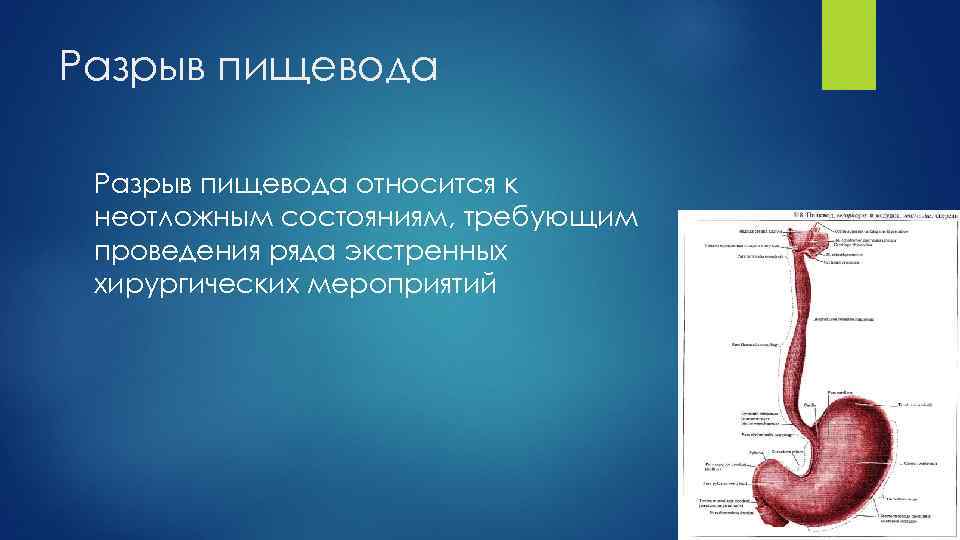 Разрыв пищевода относится к неотложным состояниям, требующим проведения ряда экстренных хирургических мероприятий 