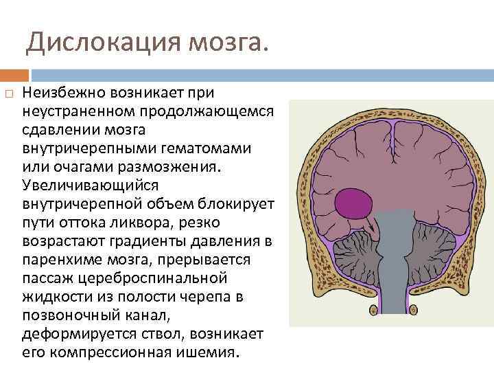 Дислокация мозга. Неизбежно возникает при неустраненном продолжающемся сдавлении мозга внутричерепными гематомами или очагами размозжения.