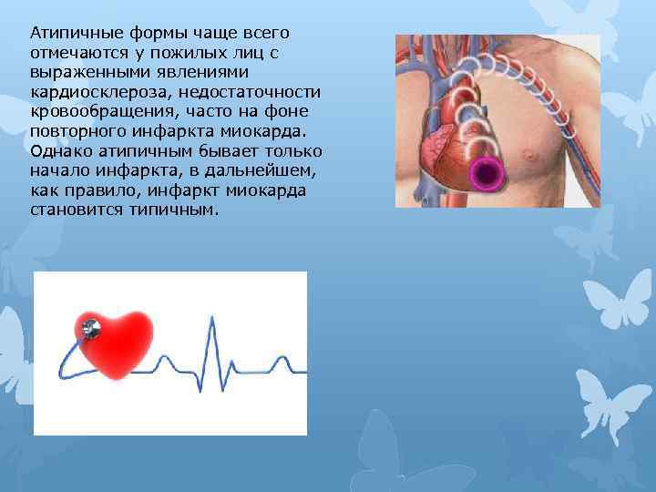 Атипичные формы чаще всего отмечаются у пожилых лиц с выраженными явлениями кардиосклероза, недостаточности кровообращения,
