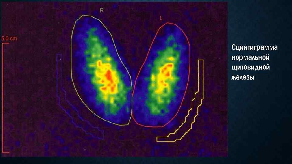 Сцинтиграмма нормальной щитовидной железы 