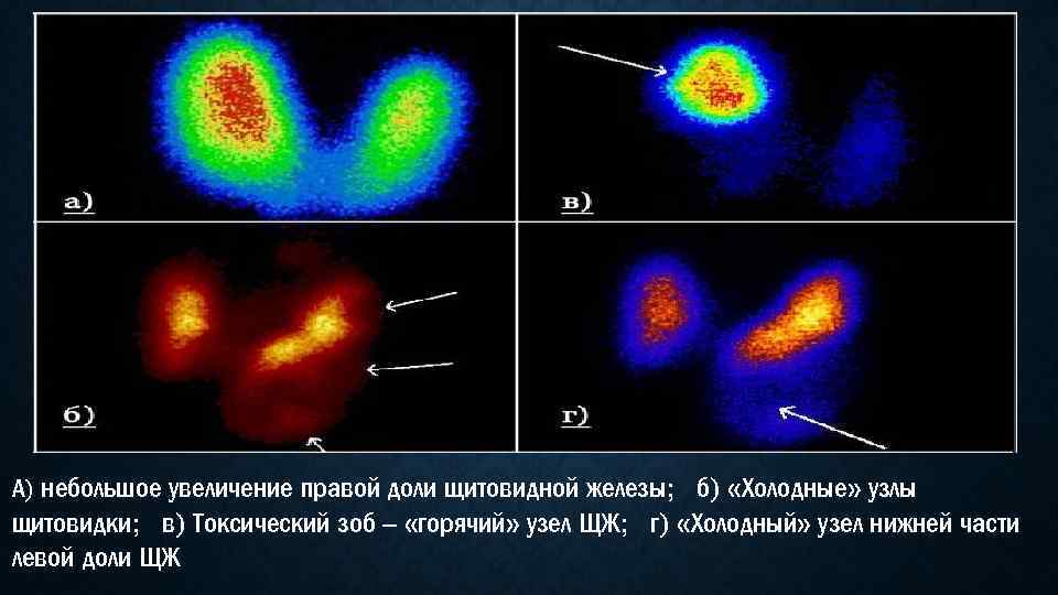 А) небольшое увеличение правой доли щитовидной железы; б) «Холодные» узлы щитовидки; в) Токсический зоб