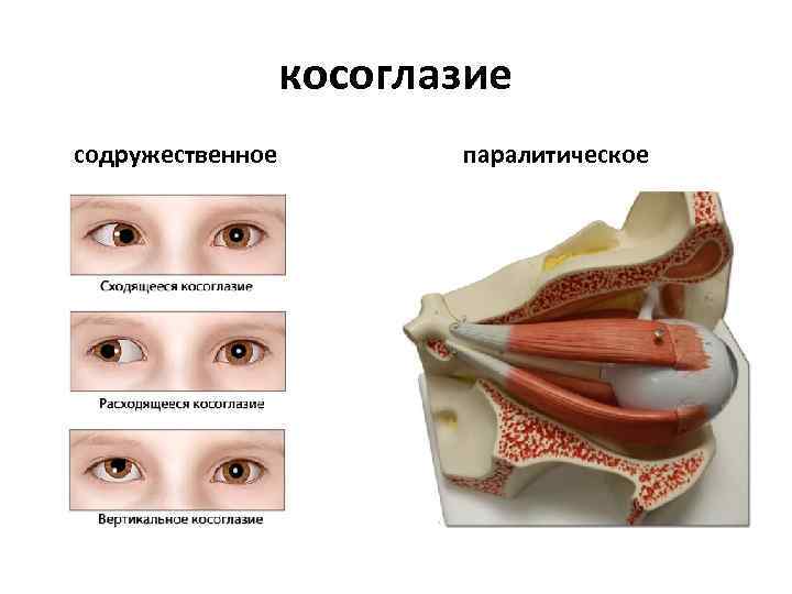 косоглазие содружественное паралитическое 