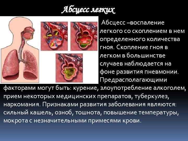 Абсцесс легких Абсцесс –воспаление легкого со скоплением в нем определенного количества гноя. Скопление гноя