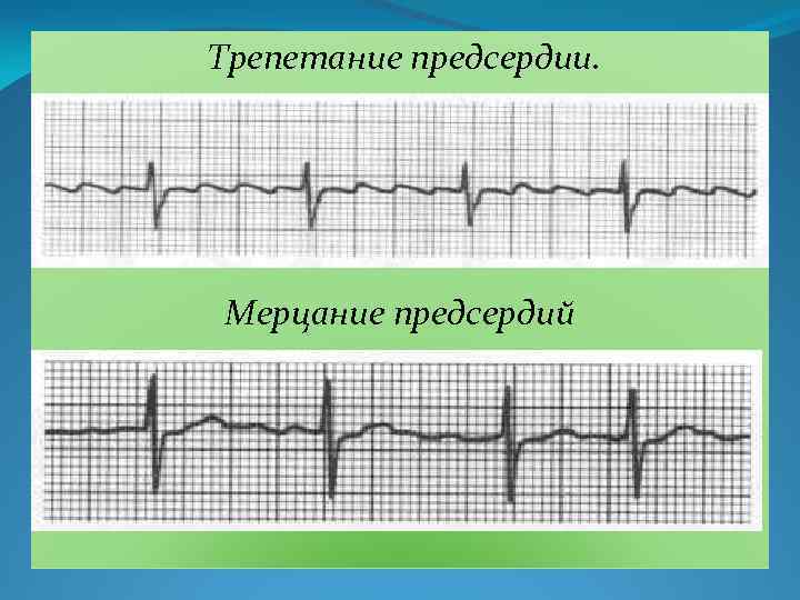 Трепетание предсердии. Мерцание предсердий 