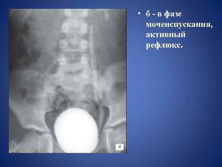  • б - в фазе мочеиспускания, активный рефлюкс. 