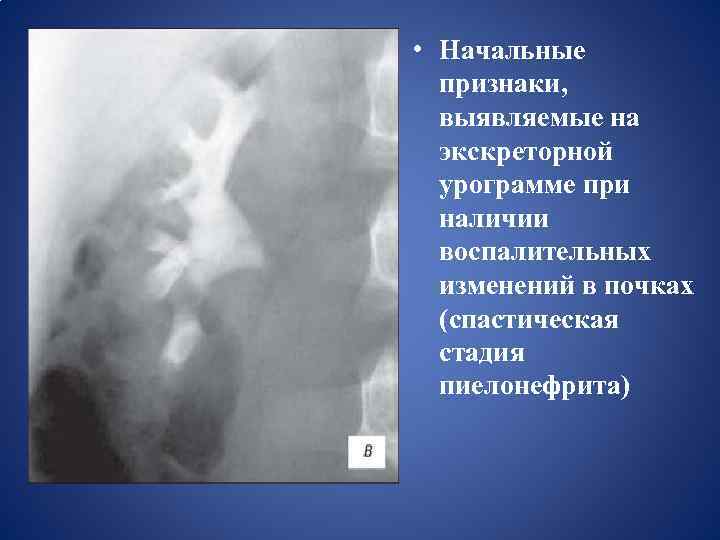  • Начальные признаки, выявляемые на экскреторной урограмме при наличии воспалительных изменений в почках