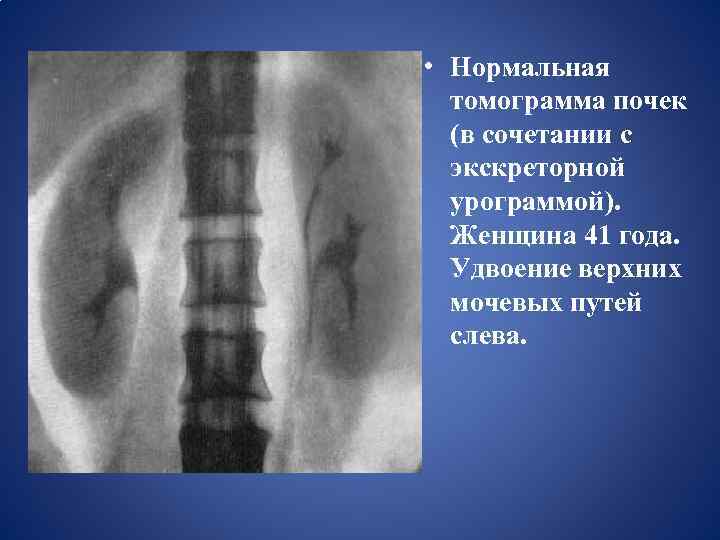  • Нормальная томограмма почек (в сочетании с экскреторной урограммой). Женщина 41 года. Удвоение