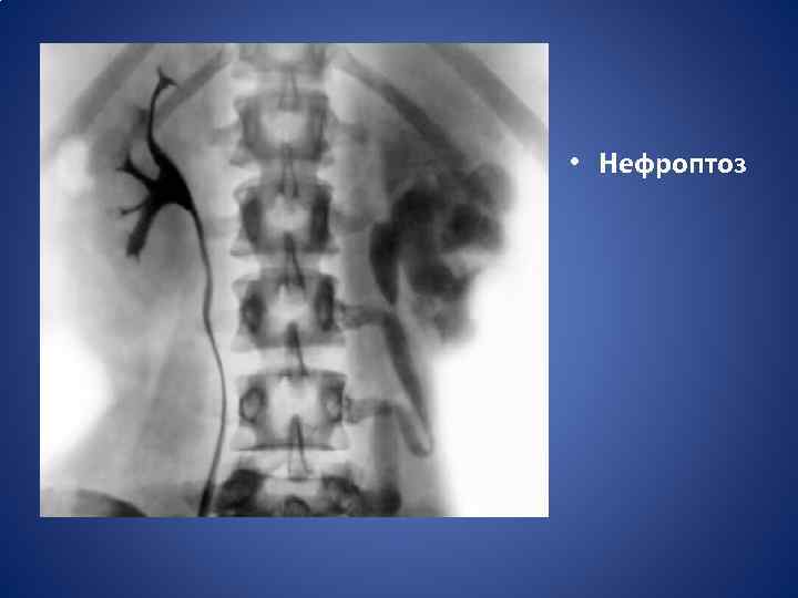  • Нефроптоз 
