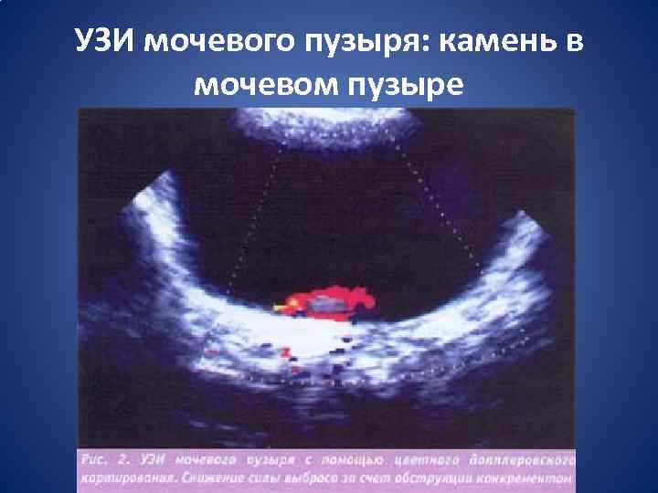 УЗИ мочевого пузыря: камень в мочевом пузыре 