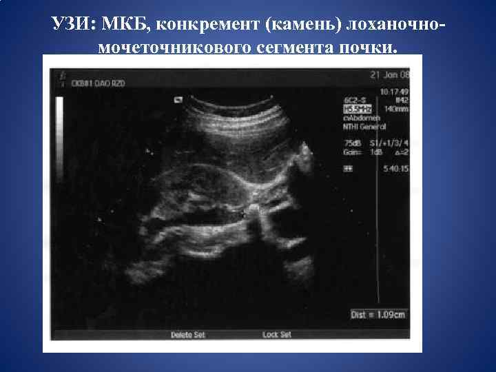 УЗИ: МКБ, конкремент (камень) лоханочномочеточникового сегмента почки. 