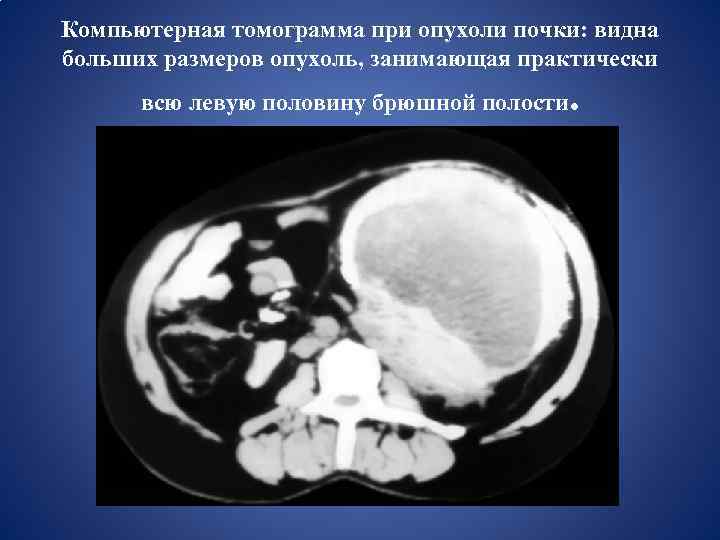 Компьютерная томограмма при опухоли почки: видна больших размеров опухоль, занимающая практически всю левую половину