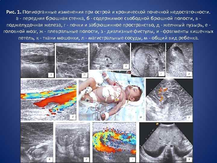  Рис. 1. Полиорганные изменения при острой и хронической почечной недостаточности. а - передняя