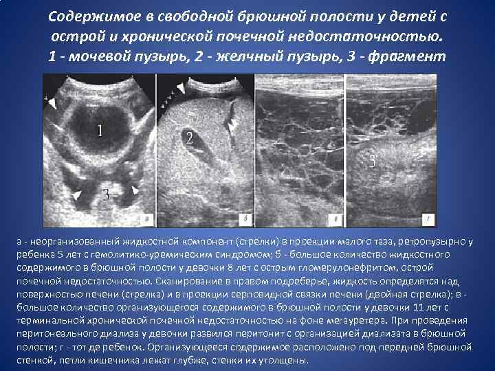 Содержимое в свободной брюшной полости у детей с острой и хронической почечной недостаточностью. 1