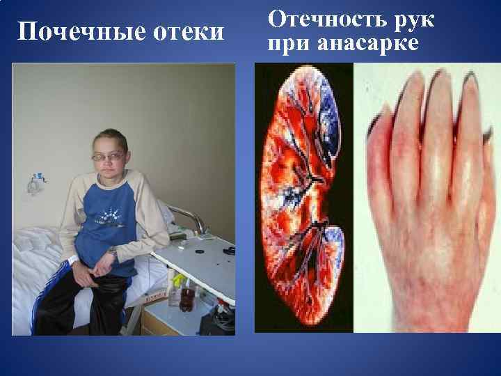 Почечные отеки Отечность рук при анасарке 