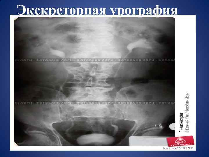 Экскреторная урография 