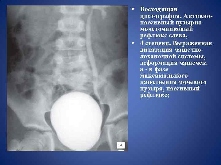  • Восходящая цистография. Активнопассивный пузырномочеточниковый рефлюкс слева, • 4 степени. Выраженная дилатация чашечнолоханочной