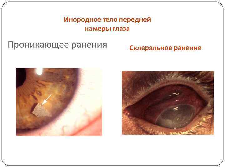 Инородное тело передней камеры глаза Проникающее ранения Склеральное ранение 