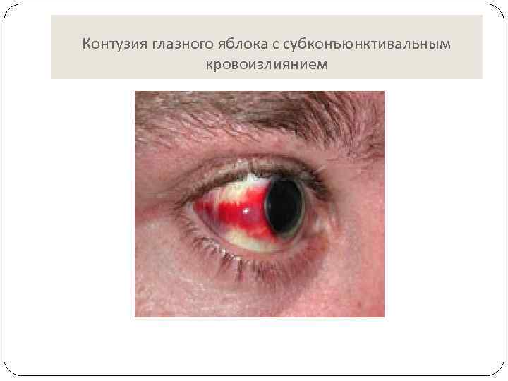 Контузия глазного яблока с субконъюнктивальным кровоизлиянием 