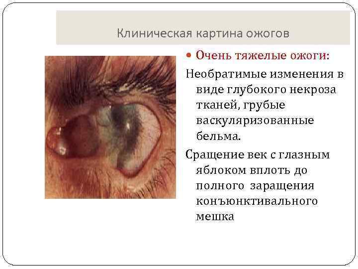 Клиническая картина ожогов Очень тяжелые ожоги: Необратимые изменения в виде глубокого некроза тканей, грубые