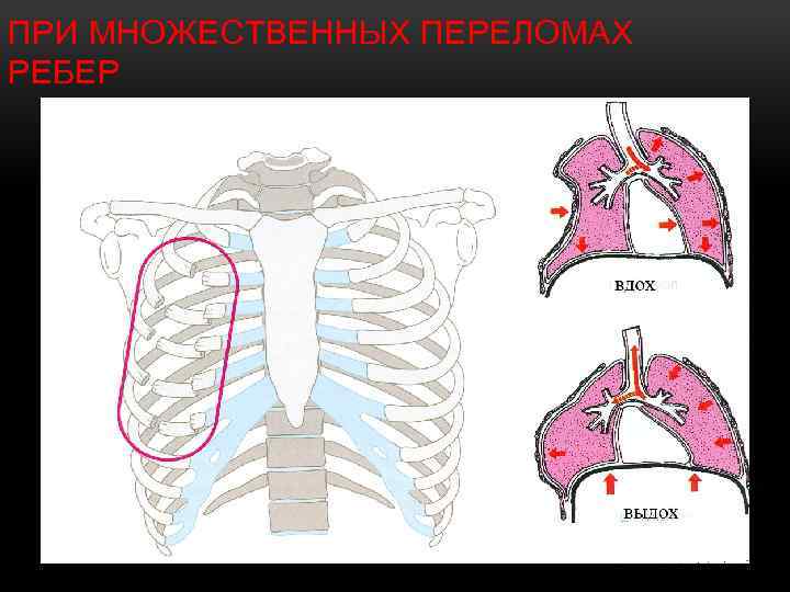 ПРИ МНОЖЕСТВЕННЫХ ПЕРЕЛОМАХ РЕБЕР 