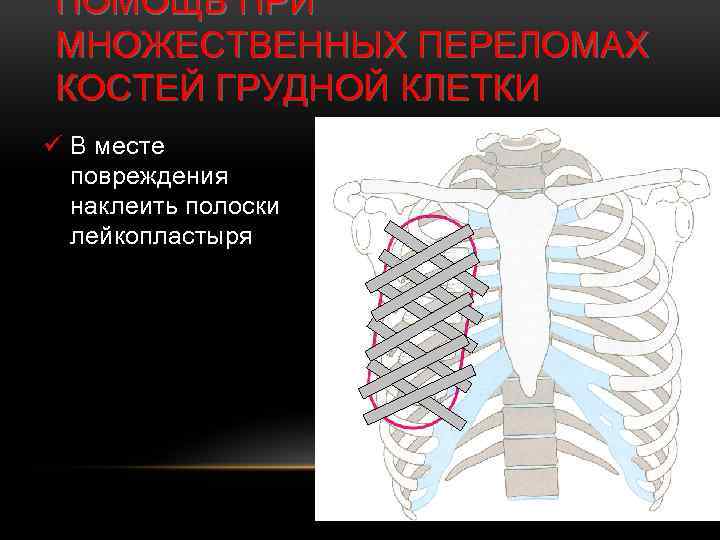 ПОМОЩЬ ПРИ МНОЖЕСТВЕННЫХ ПЕРЕЛОМАХ КОСТЕЙ ГРУДНОЙ КЛЕТКИ ü В месте повреждения наклеить полоски лейкопластыря