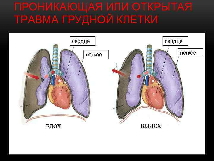 ПРОНИКАЮЩАЯ ИЛИ ОТКРЫТАЯ ТРАВМА ГРУДНОЙ КЛЕТКИ сердце легкое 