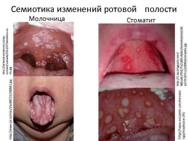 logy/mouthulcer. JPG http: //1. bp. blogspot. com/Nt 0 cz. MJ 7 RJE/T 3 CU