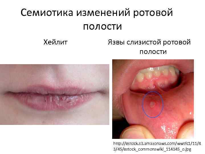 Семиотика изменений ротовой полости Хейлит Язвы слизистой ротовой полости http: //estock. s 3. amazonaws.