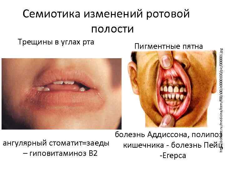 Трещины в углах рта Пигментные пятна http: //sohmet. ru/medicina/item/f 00/s 00/e 0000100/pic/000001. jpg Семиотика