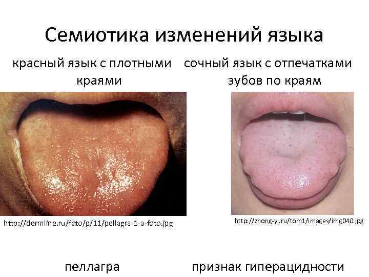 Семиотика изменений языка красный язык с плотными сочный язык с отпечатками краями зубов по