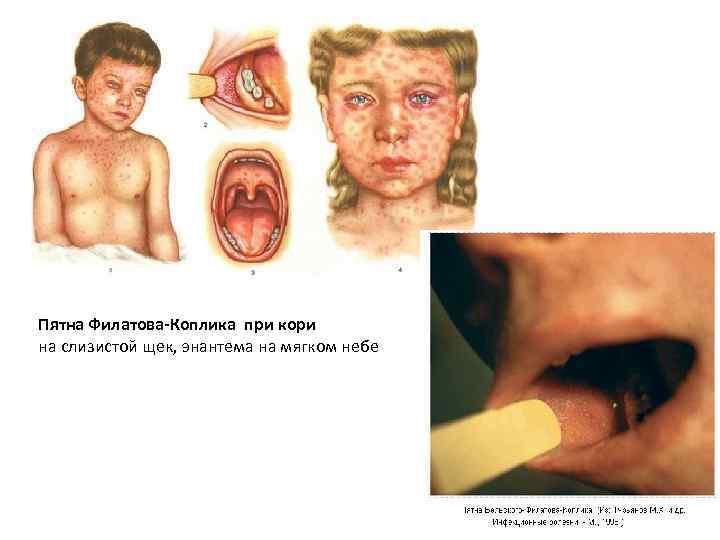 Пятна Филатова-Коплика при кори на слизистой щек, энантема на мягком небе 