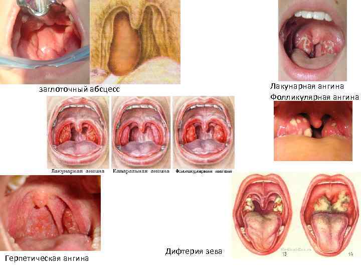 Лакунарная ангина Фолликулярная ангина заглоточный абсцесс Герпетическая ангина Дифтерия зева 