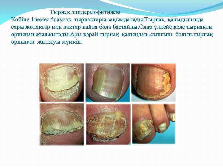  Тырнақ эпидермофитиясы Көбіне 1 немес 5 саусақ тырнақтары зақымдалады. Тырнақ қалыдығында сары жолақтар