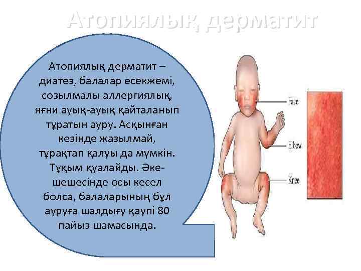 Атопиялық дерматит презентация