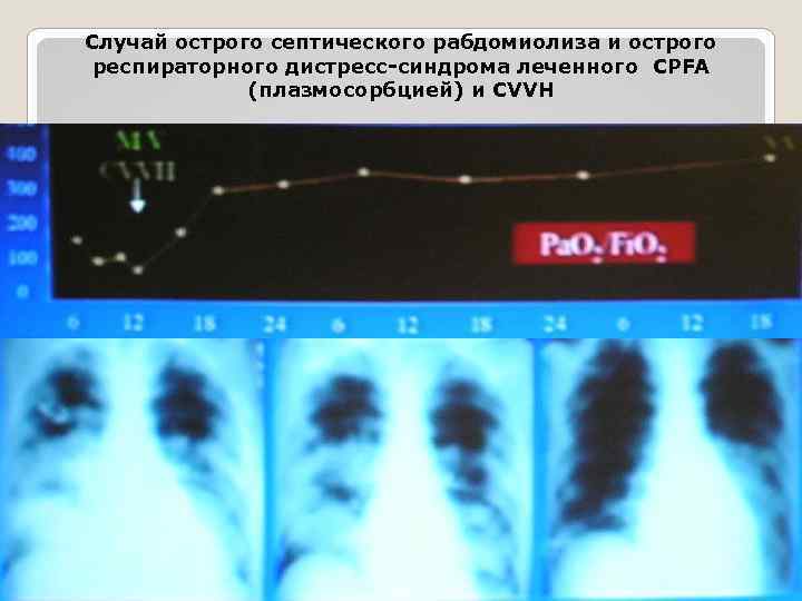 Случай острого септического рабдомиолиза и острого респираторного дистресс-синдрома леченного CPFA (плазмосорбцией) и CVVH 