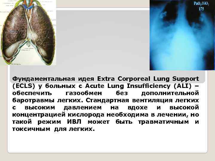 Фундаментальная идея Extra Corporeal Lung Support (ECLS) у больных c Acute Lung Insufficiency (ALI)