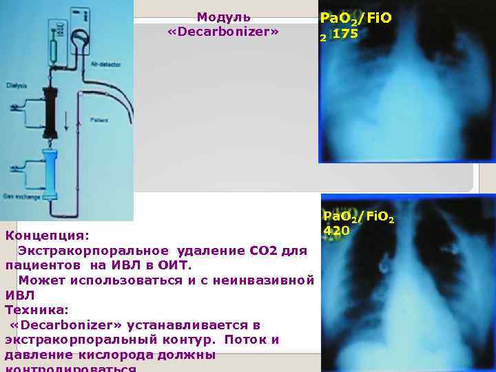 Модуль «Decarbonizer» Концепция: Экстракорпоральное удаление СО 2 для пациентов на ИВЛ в ОИТ. Может
