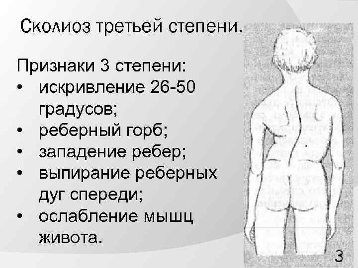 Сколиоз третьей степени. Признаки 3 степени: • искривление 26 -50 градусов; • реберный горб;