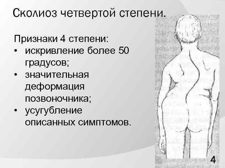 Сколиоз четвертой степени. Признаки 4 степени: • искривление более 50 градусов; • значительная деформация