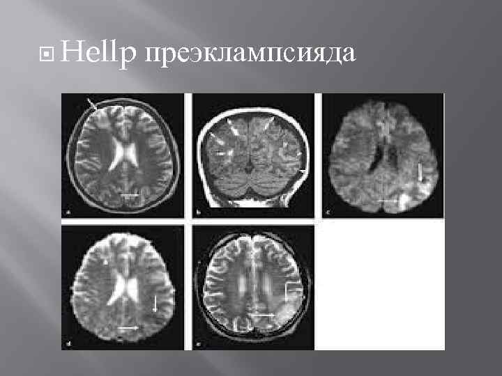  Hellp преэклампсияда 